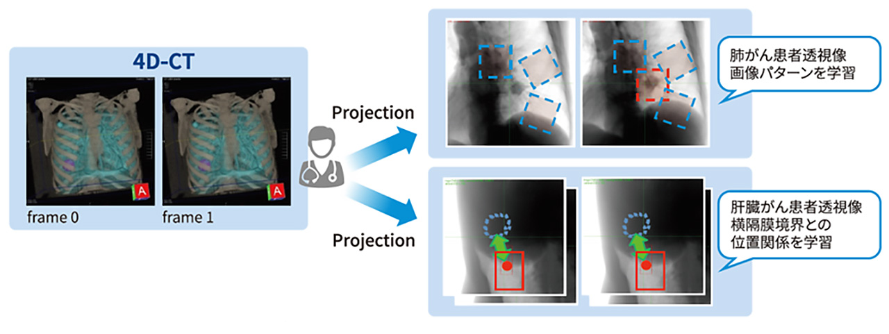 重粒子線治療向け腫瘍追跡イメージ