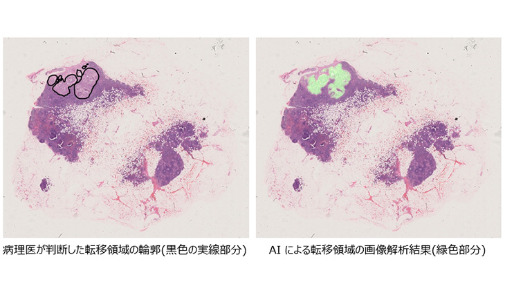病理画像における胃がんリンパ節転移検出分析