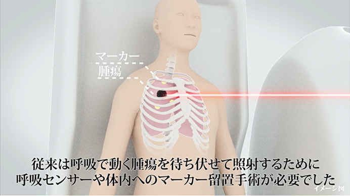 重粒子線がん治療向け腫瘍追跡技術