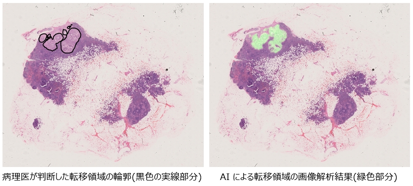 病理画像における胃がんリンパ節転移検出分析イメージ