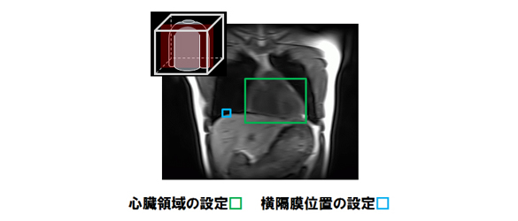 胸部の3次元MRI画像から心臓領域および横隔膜位置を自動的に検出する技術の図