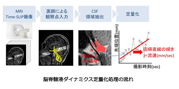 脳脊髄液ダイナミクス定量化処理の流れ