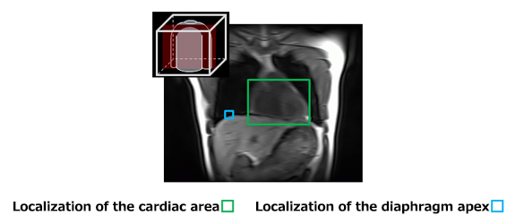 Development of a technology for automatic localization of the cardiac area and diaphragm from a chest 3-D MRI