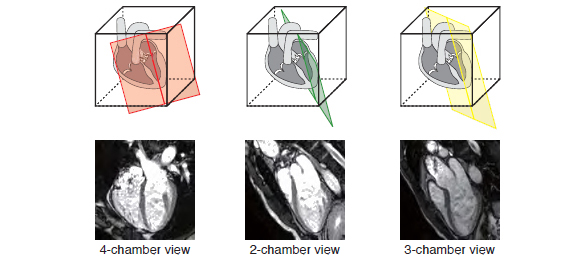 Automatic slice alignment for cardiac MRI