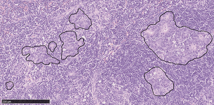 図1 胃がんのリンパ節転移(リンパ節のHE染色組織像：実線で囲まれた部分が転移組織)