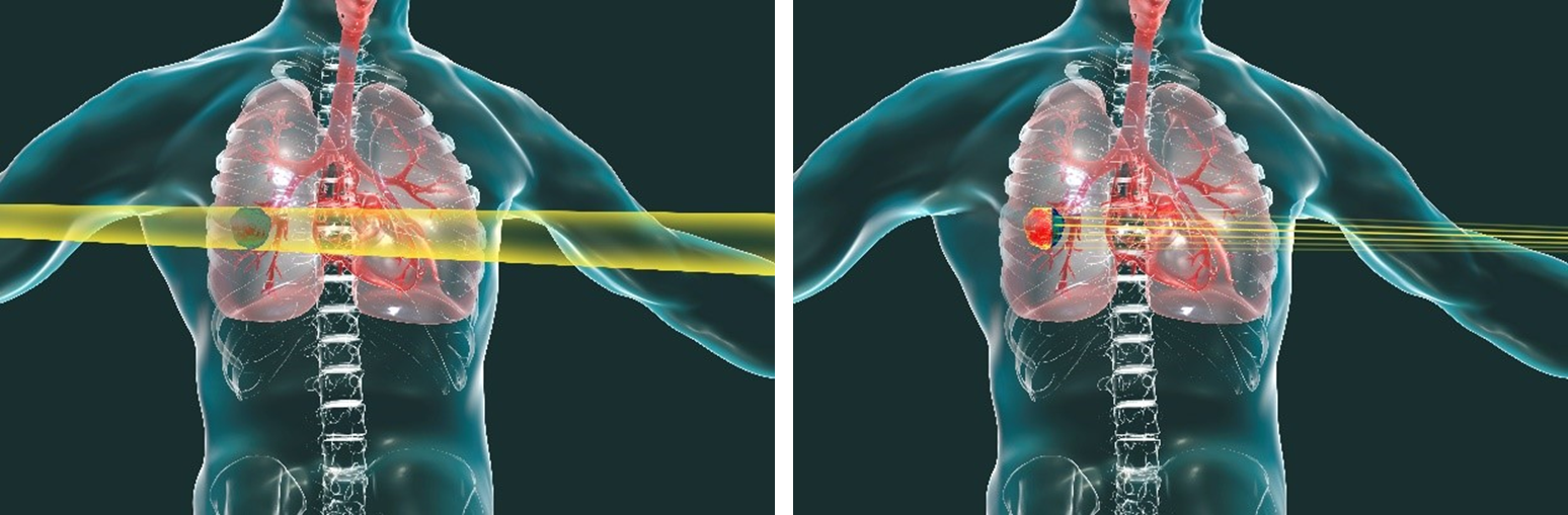 X-ray (left) and heavy-ion beams (right). Heavy ion beams stop at the tumor, minimizing damage to normal tissue.