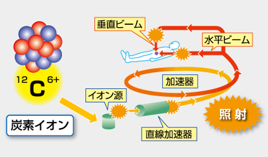 炭素イオンを照射する仕組み