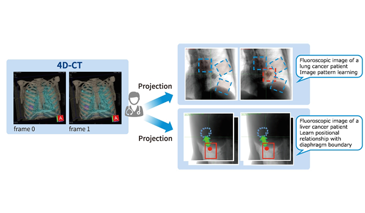 Tumor tracking for heavy-ion radiotherapy Image