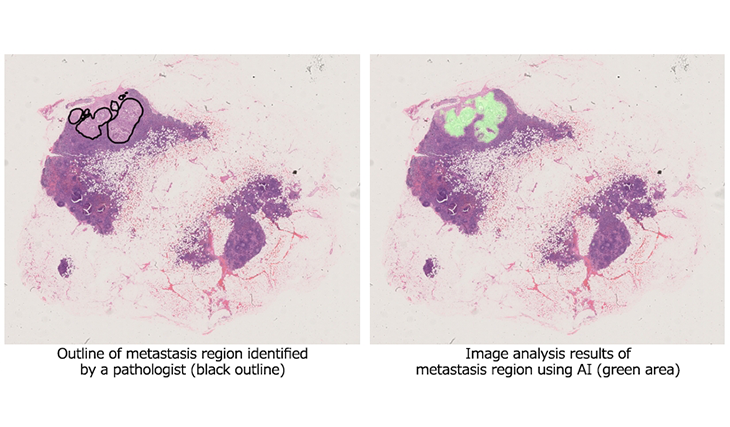 Detect and analyze lymph node metastasis in gastric cancer patients using pathology images Image