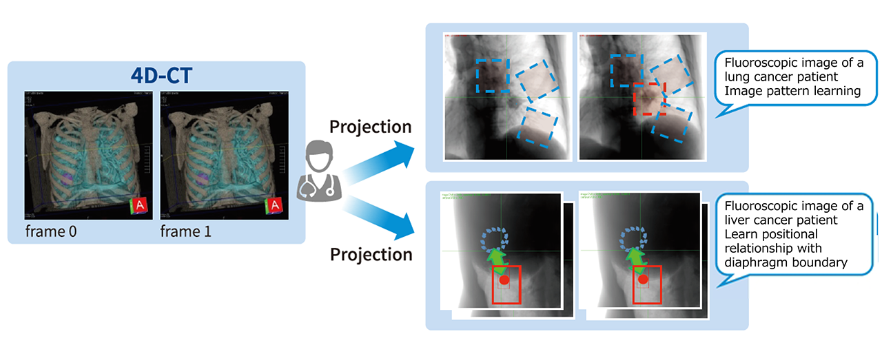 Tumor tracking for heavy-ion radiotherapy Image